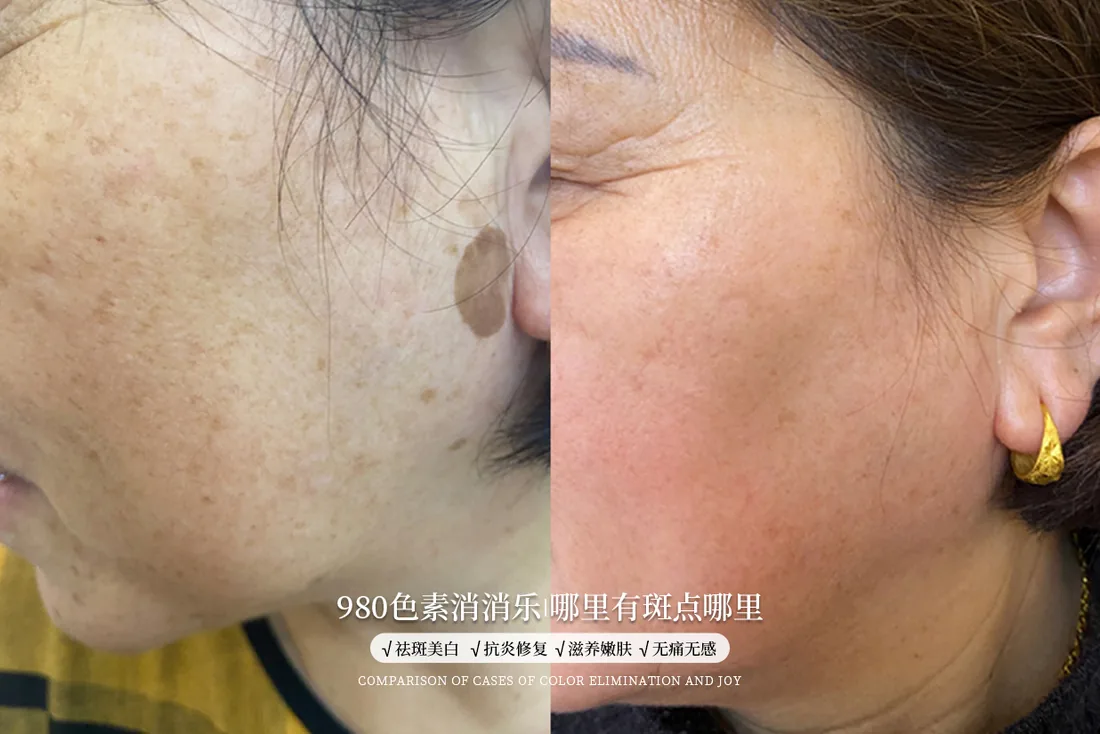 BE U Careal 色素护理真实前后对比